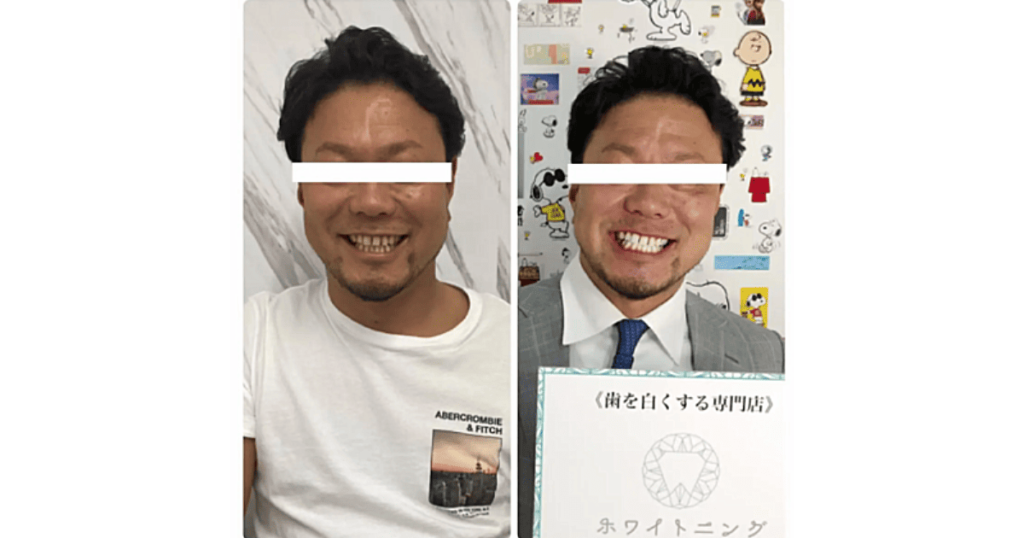 ホワイトニング